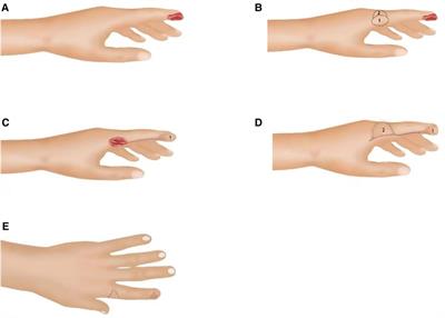 Repair of fingertip defect with reverse digital artery island flap and repair of donor site with digital dorsal advancement flap